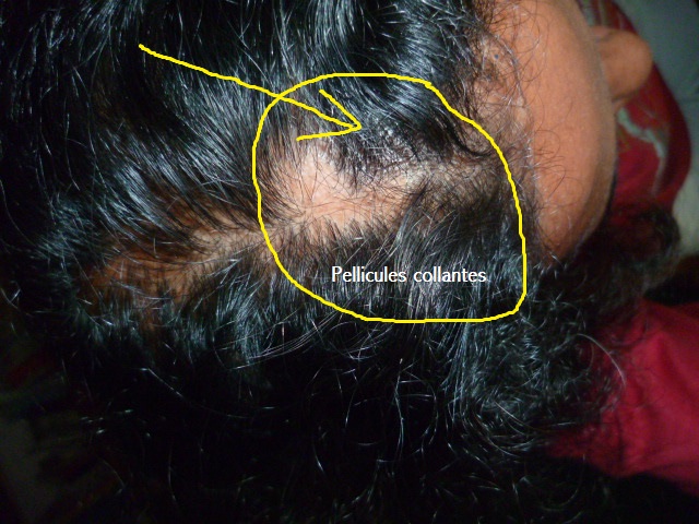 pellicules qui collent